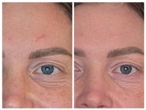 Paradise Medical Maui, Forehead scar before and after treatment, showing skin healing.
