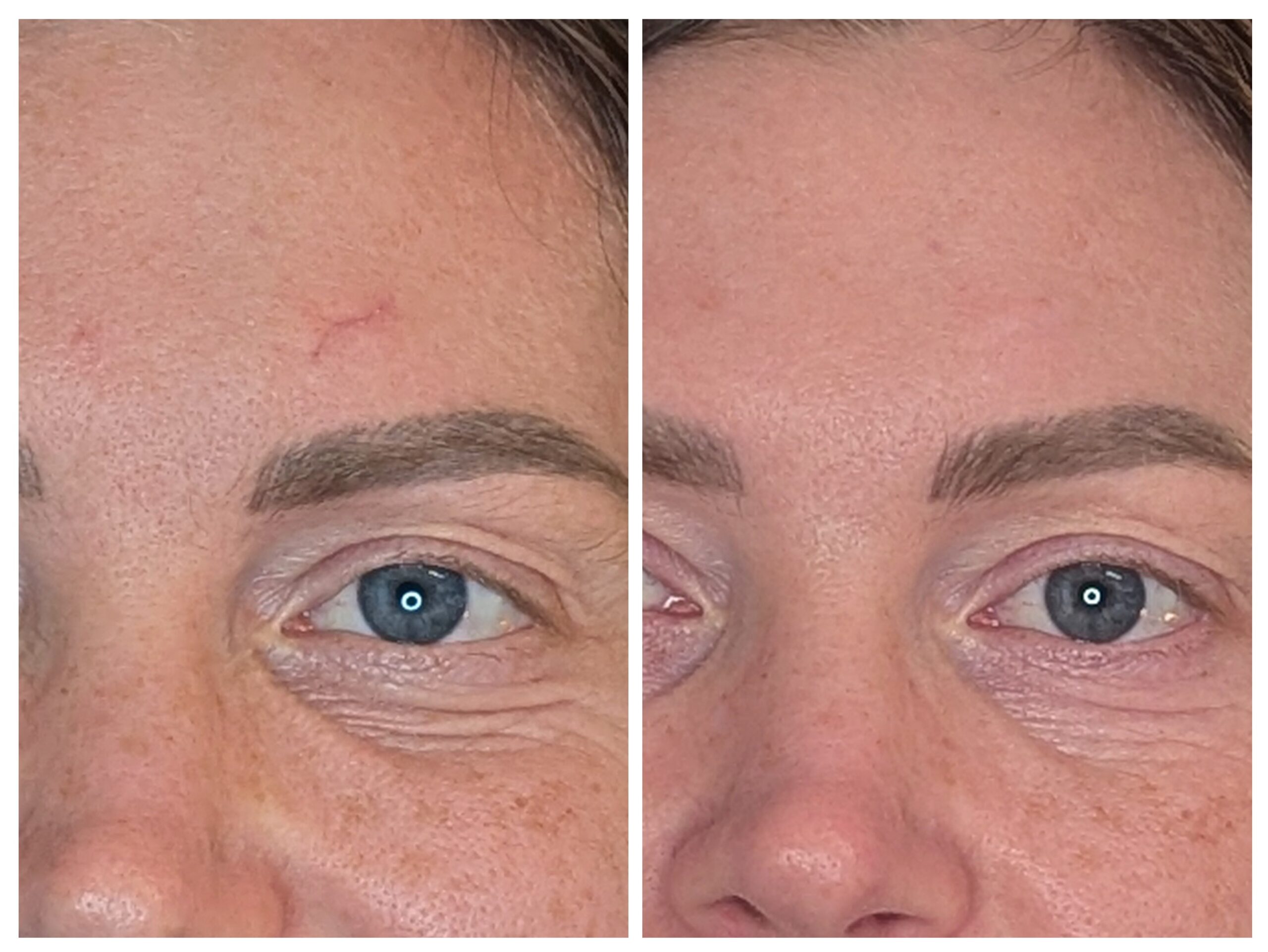 The biology of scars: what actually happens in the skin
