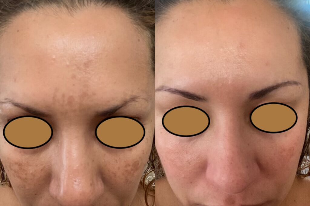 Melasma Treatment in Maui: A Functional & Holistic Approach to Radiant Skin
