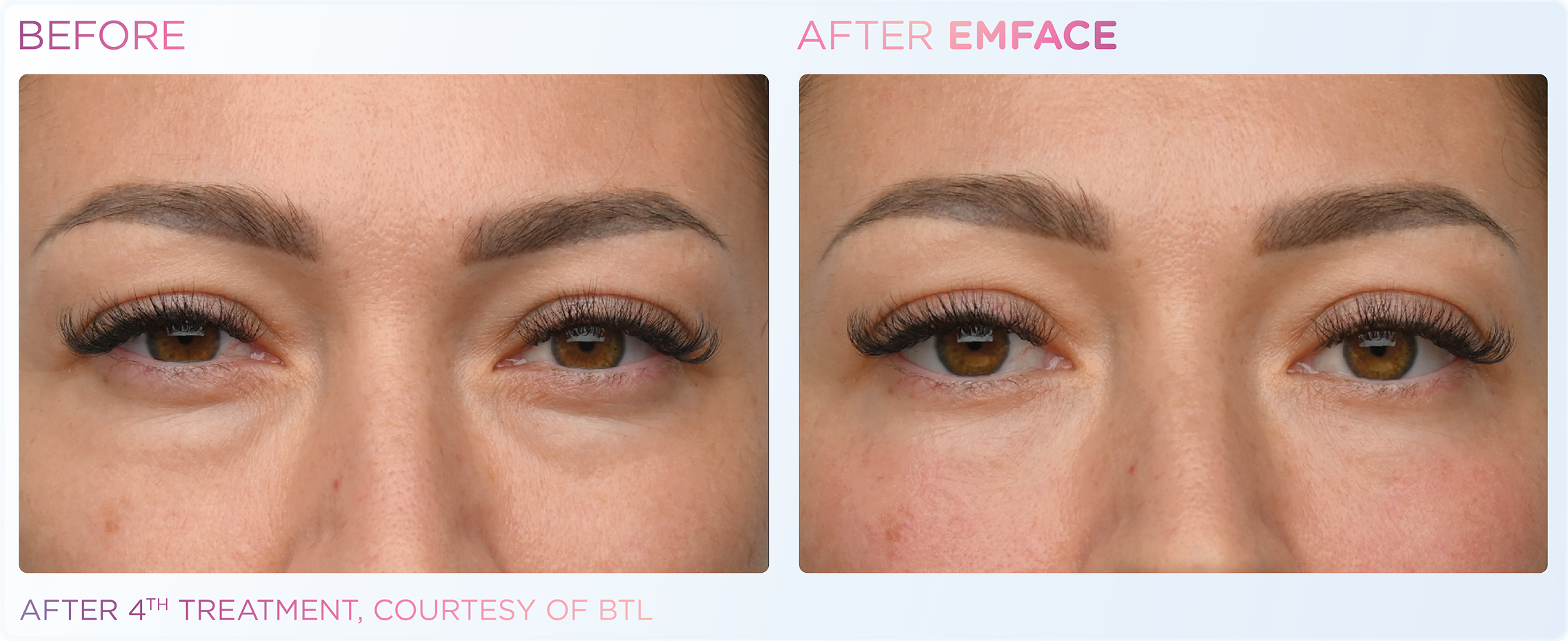 Side-by-side comparison of eyes before and after EMFACE treatment, highlighting smoother skin under the eyes and fuller brows on the right panel.