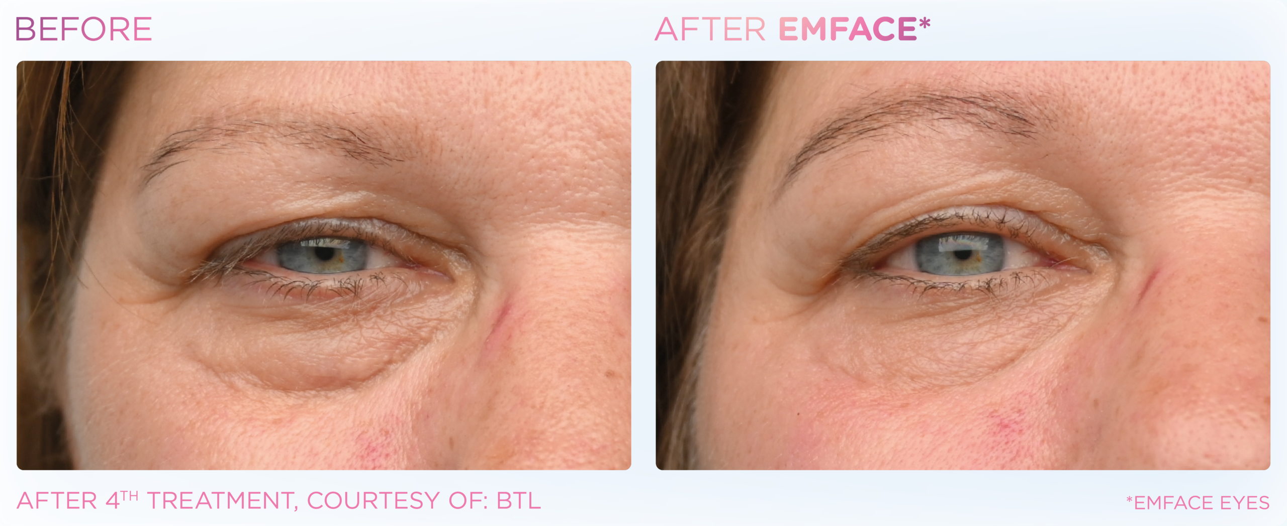 Emface Treatment: Lift, Tighten, and Rejuvenate Your Face Without Surgery
