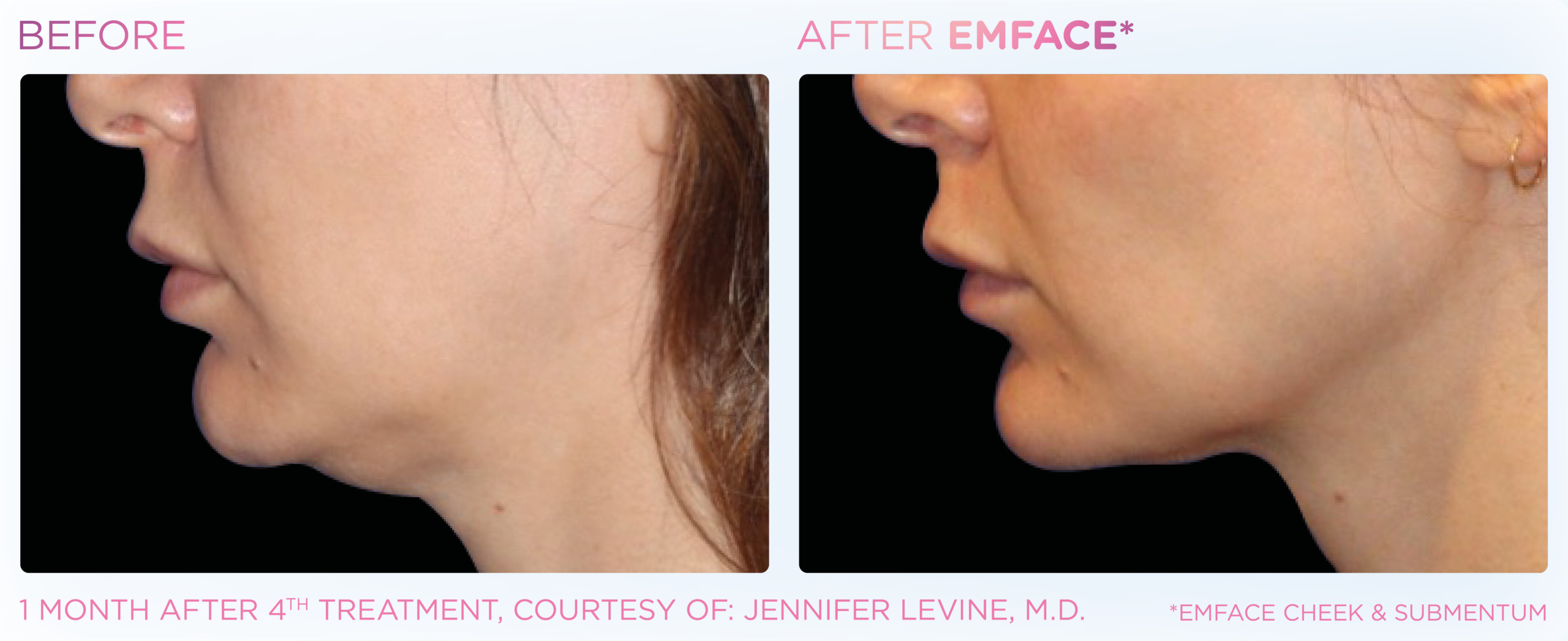 EMFACE® for Double Chin & Turkey Neck | Non-Surgical Neck Lift