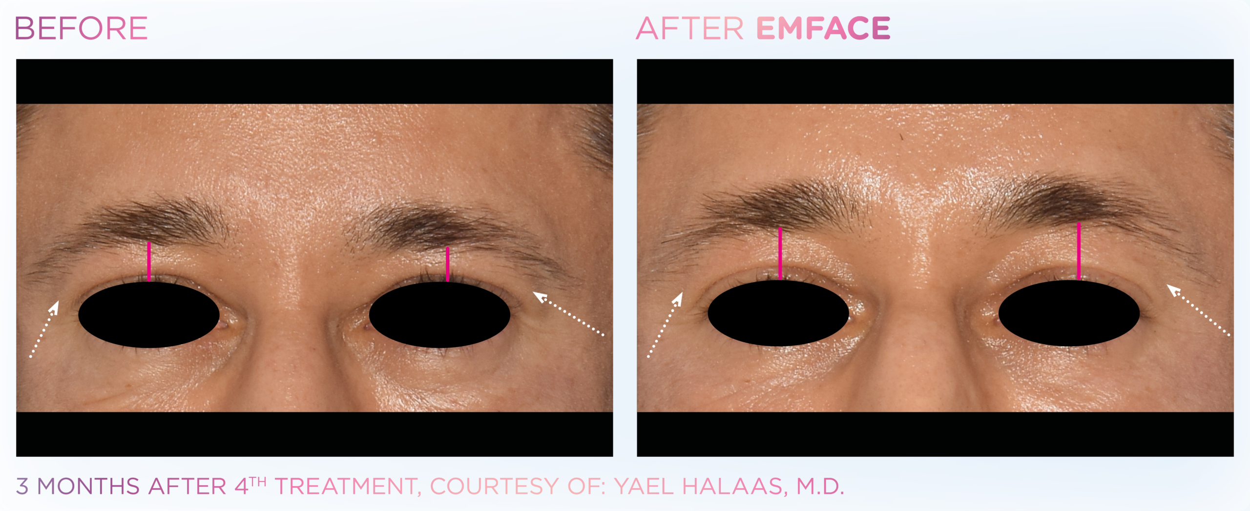 Comparison photo of a female eye area: left panel labeled BEFORE and right panel labeled AFTER EMFACE, showing improved skin texture around the eyes after treatment (eyes obscured).