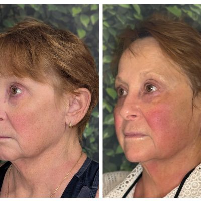 TShape Facial Series